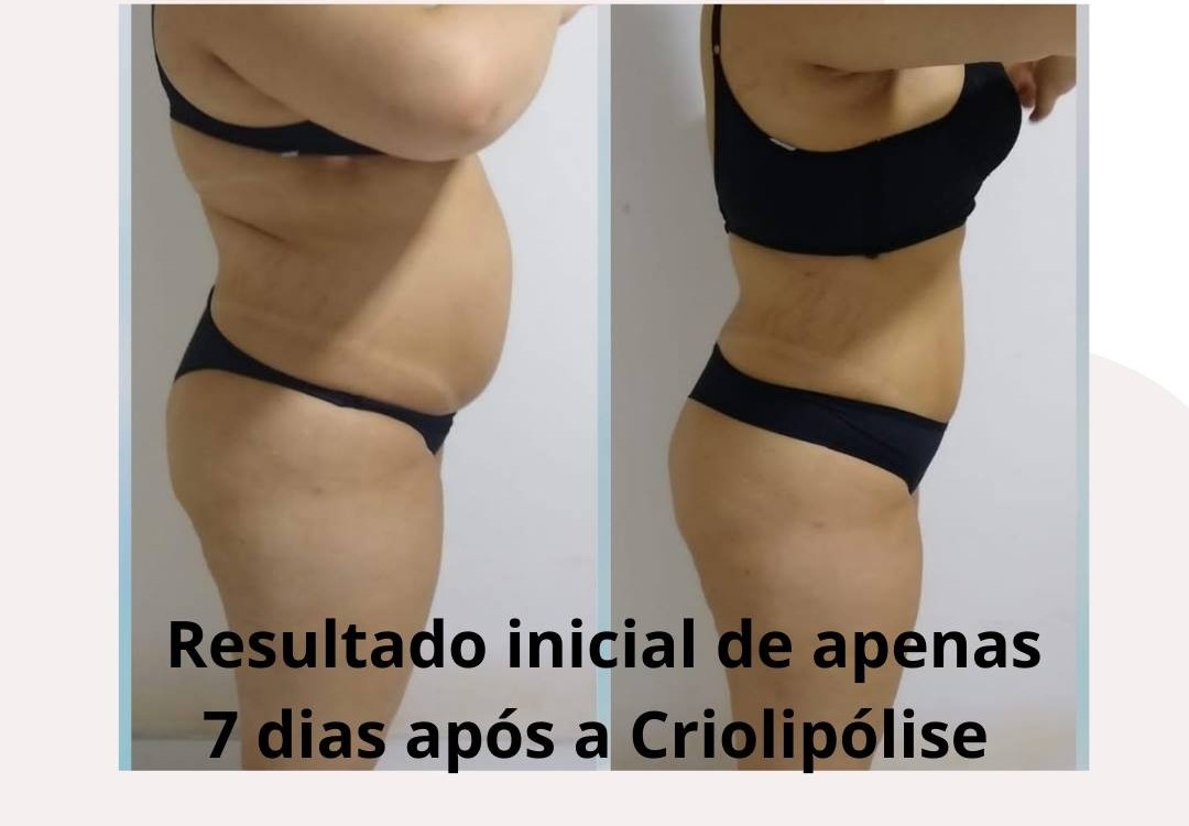 Evolução do tratamento de crio - Foto 3